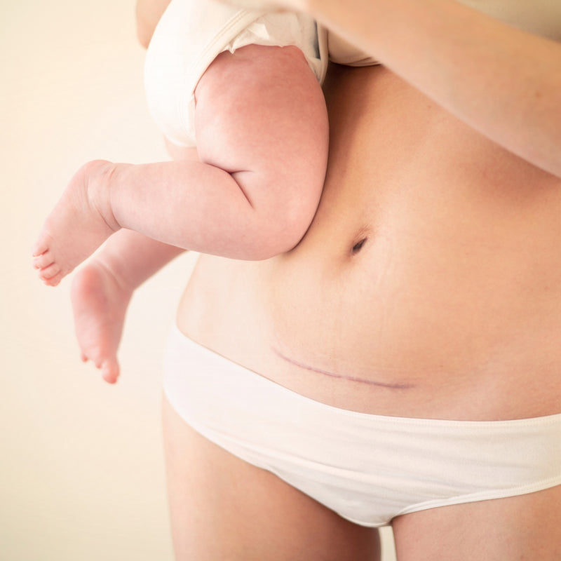 Bauch mit Kaiserschnittnarbe und Baby – Symbol für Mutterschaft