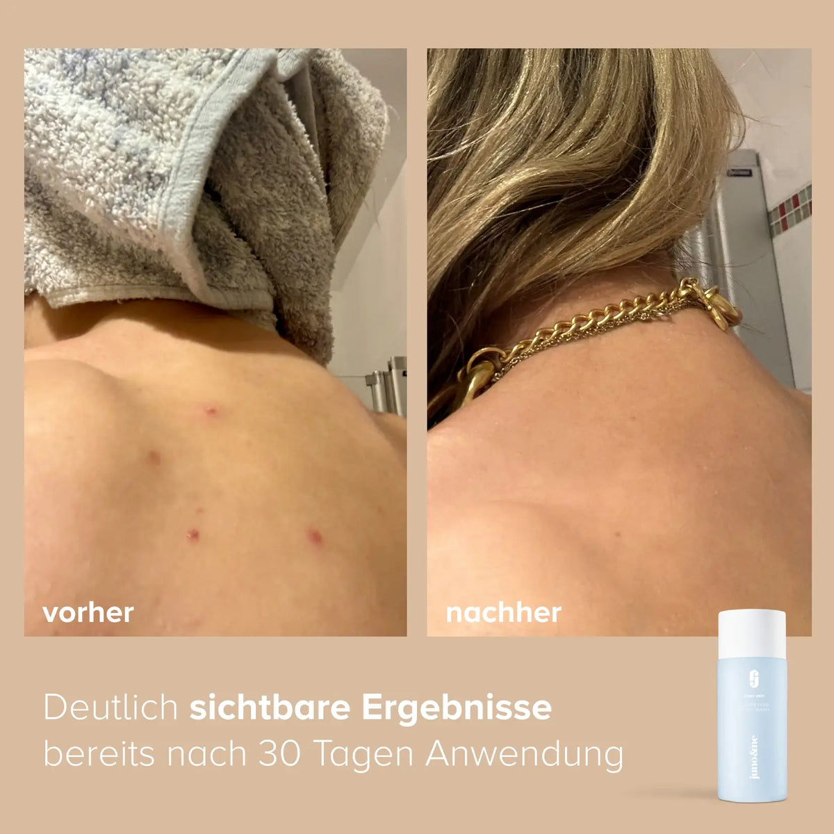 Vorher und nachher: Rücken mit Pickeln und klarere Haut nach 30 Tagen Clarifying Body Wash