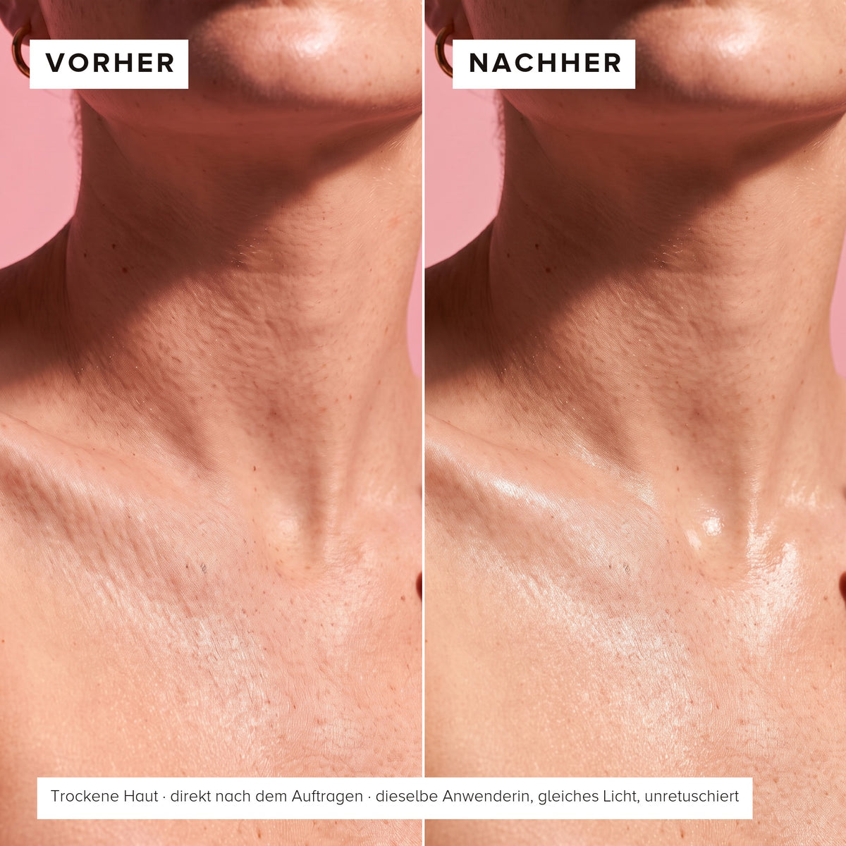 Décolleté before and after: dry skin with fine dryness lines, then visibly plumper and more even